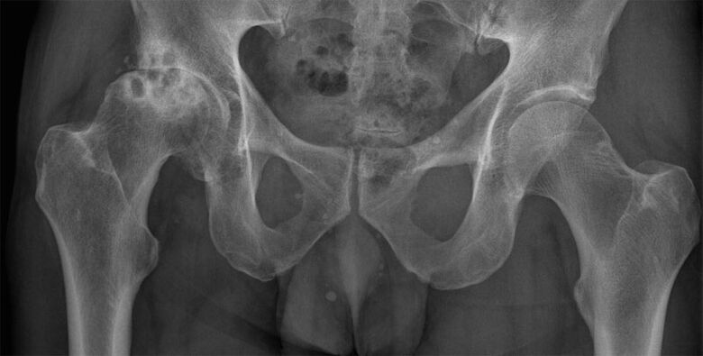 X-rayda son qo'shimchasining 3-bosqich artrozi