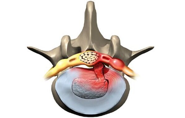 osteoxondrozdan ta'sirlangan vertebra
