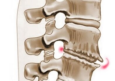 torakal osteoxondroz bilan vertebra shikastlanishi
